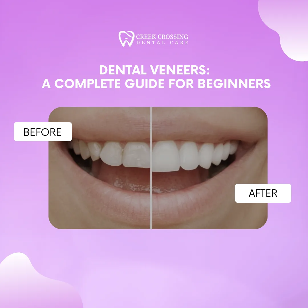 Dental Veneers: A Complete Guide for Beginners