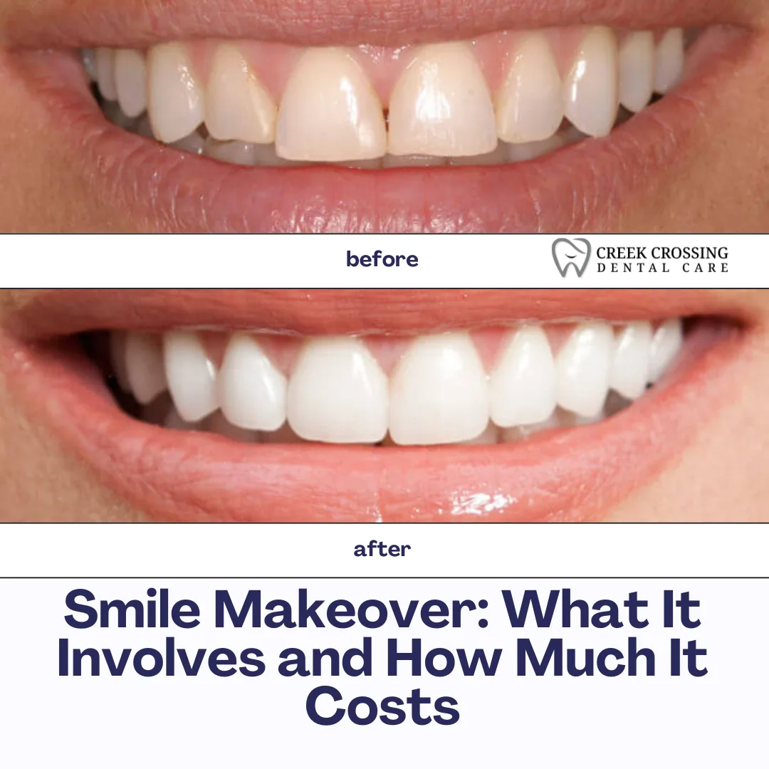Smile Makeover: What It Involves and How Much It Costs