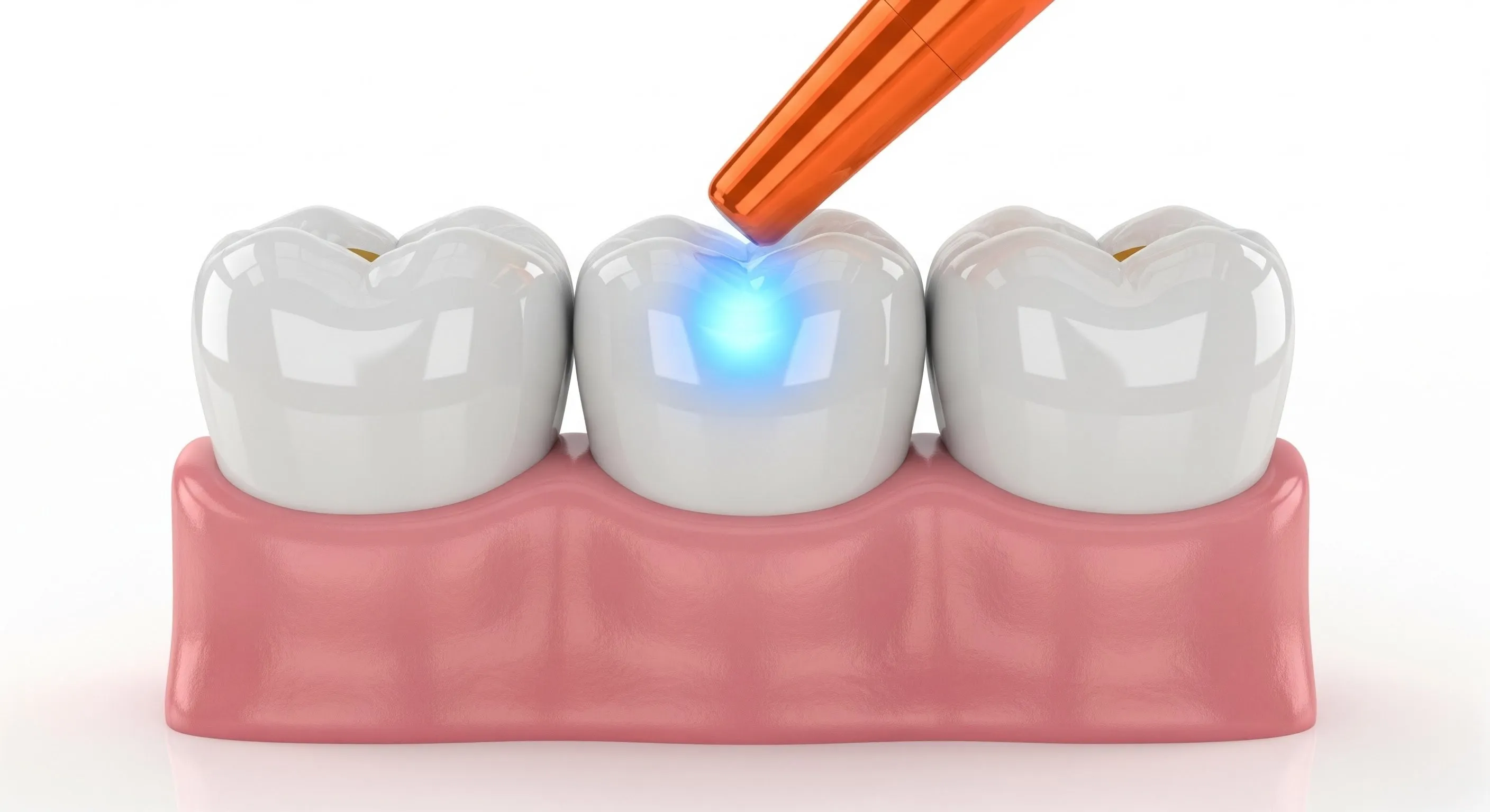 Composite Fillings Cost and Pricing Information in Mesquite